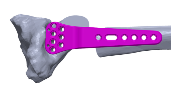 How Lerdsin Hospital Uses Metal 3D Printing to Create Patient-Specific Orthopedic Implants unbenannt.pngcad