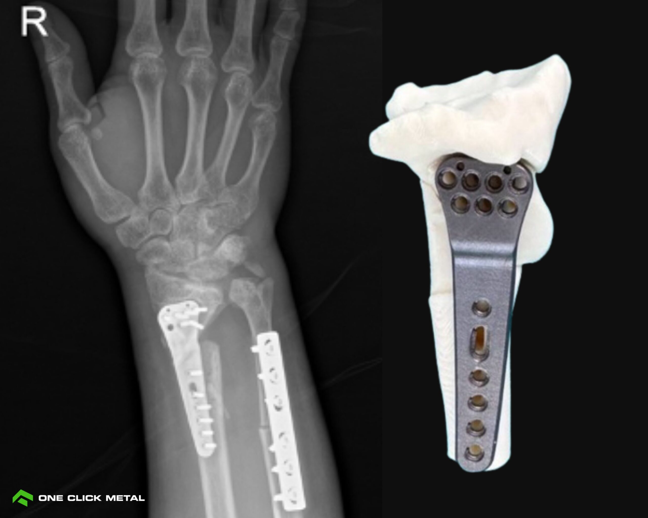 metal 3d printed implant